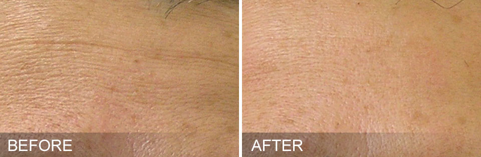 hydrafacial-before-and-after-1 coolsculpting before and after on stomach in boca raton, florida