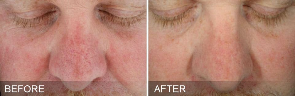 hydrafacial-before-and-after-3 before and after fat freezing on abdomen