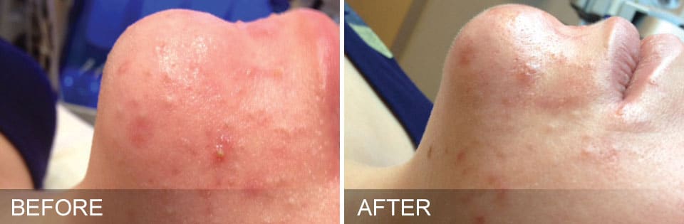 hydrafacial-before-and-after-5 before and after flanks / love handles