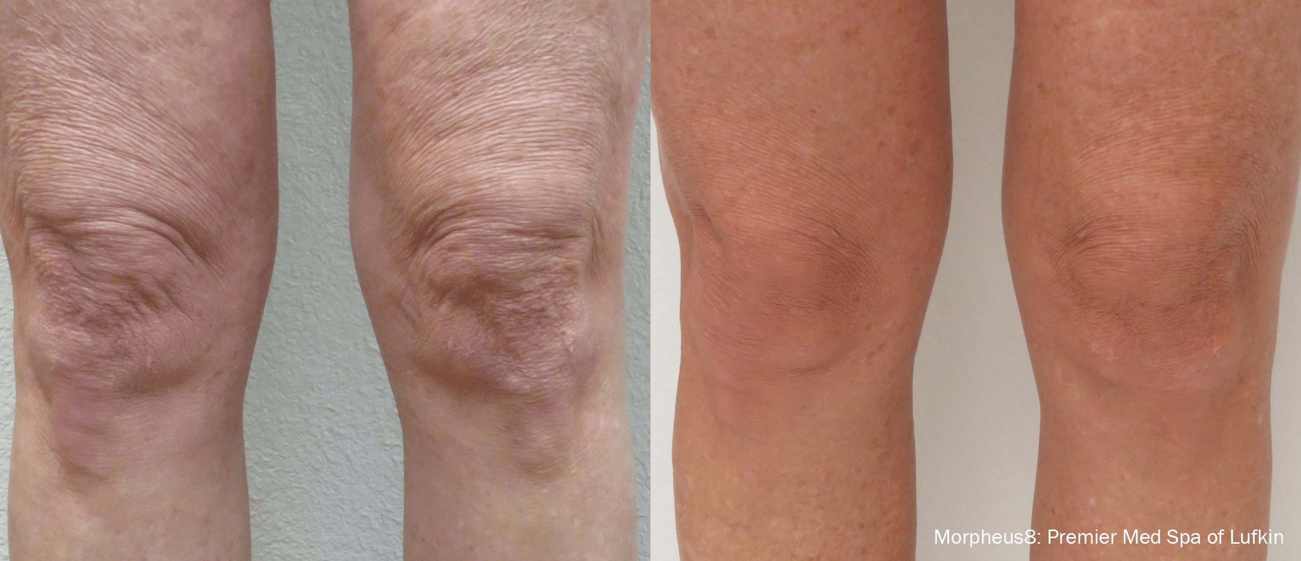 AT_Morpheus8_1_Knee before and after flanks / love handles