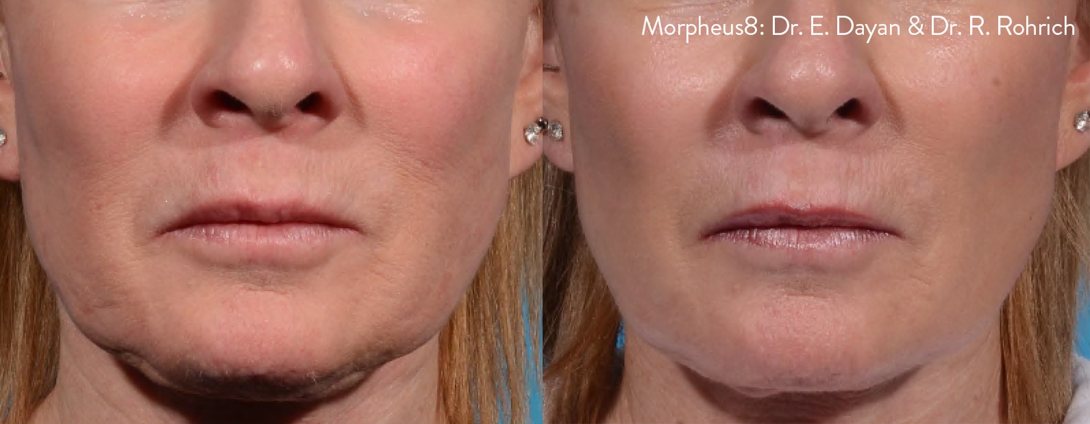 EDRR_Morpheus8_2a before and after fat freezing on abdomen