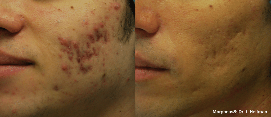 morpheus8 before and after morpheus8 before and after facial acne scars