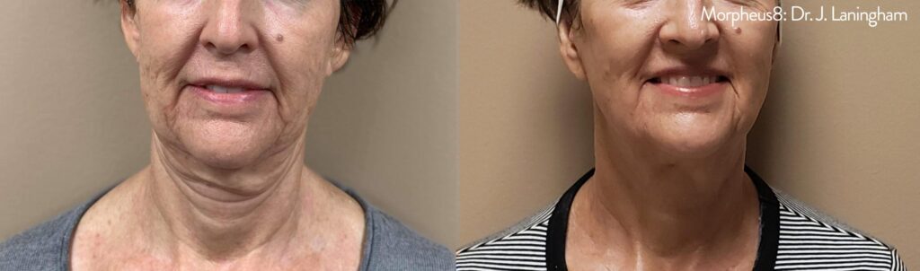 JL_Morpheus8_1a-scaled coolsculpting before and after on chin in boca raton